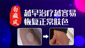 腰部白癜风白斑易扩散吗